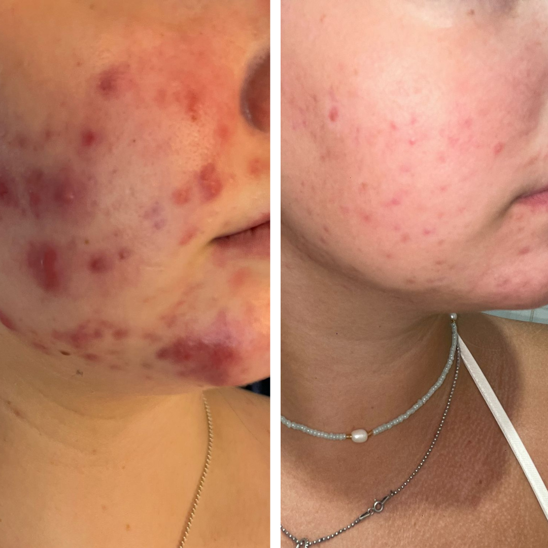 My acne caused excruciating pain but eventually I found a solution