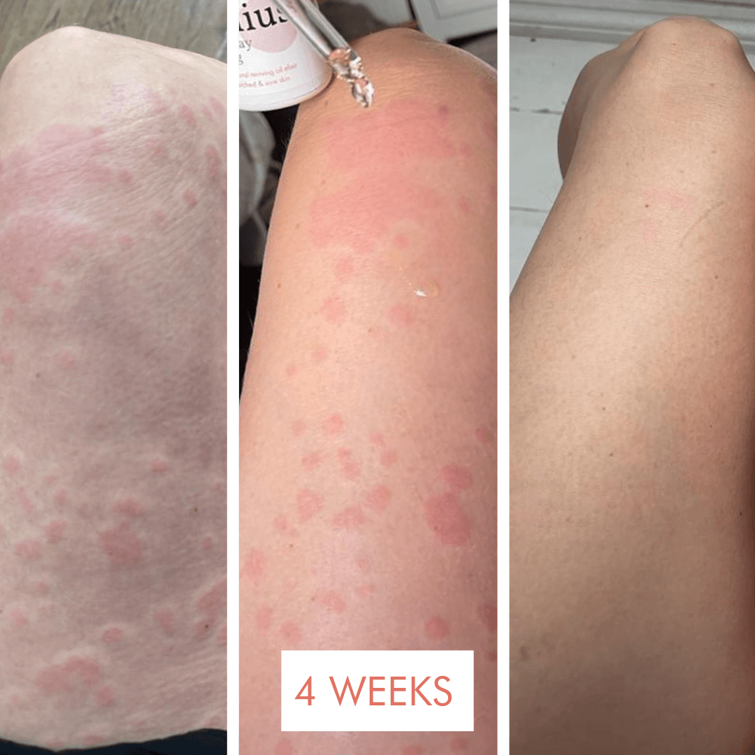 Skin:Genius helps chronic urticaria skin reaction