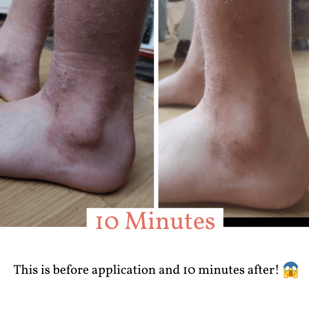 Skin:Genius ends 10 year search for eczema cure