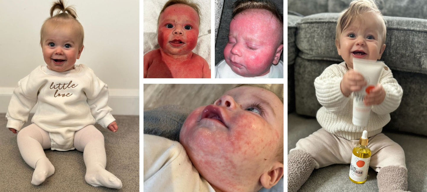 “My daughter looked like a burns victim: now her skin is baby smooth”