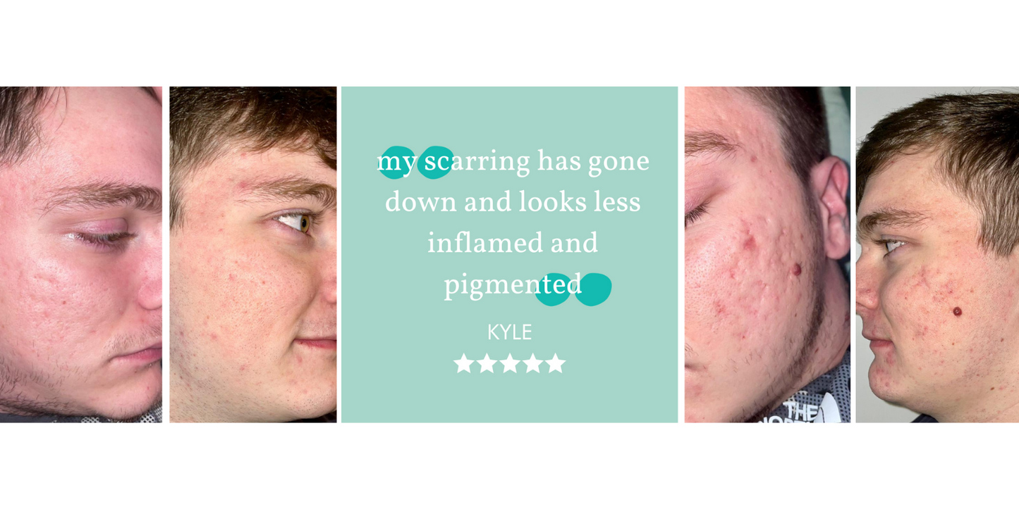 My acne is at a minimum thanks to Skin:Genius
