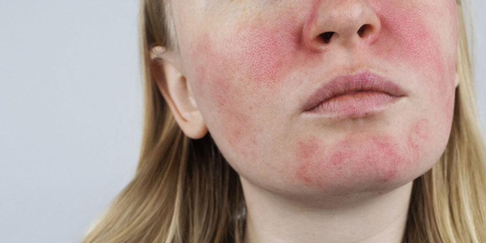 Person with roscea skin condition