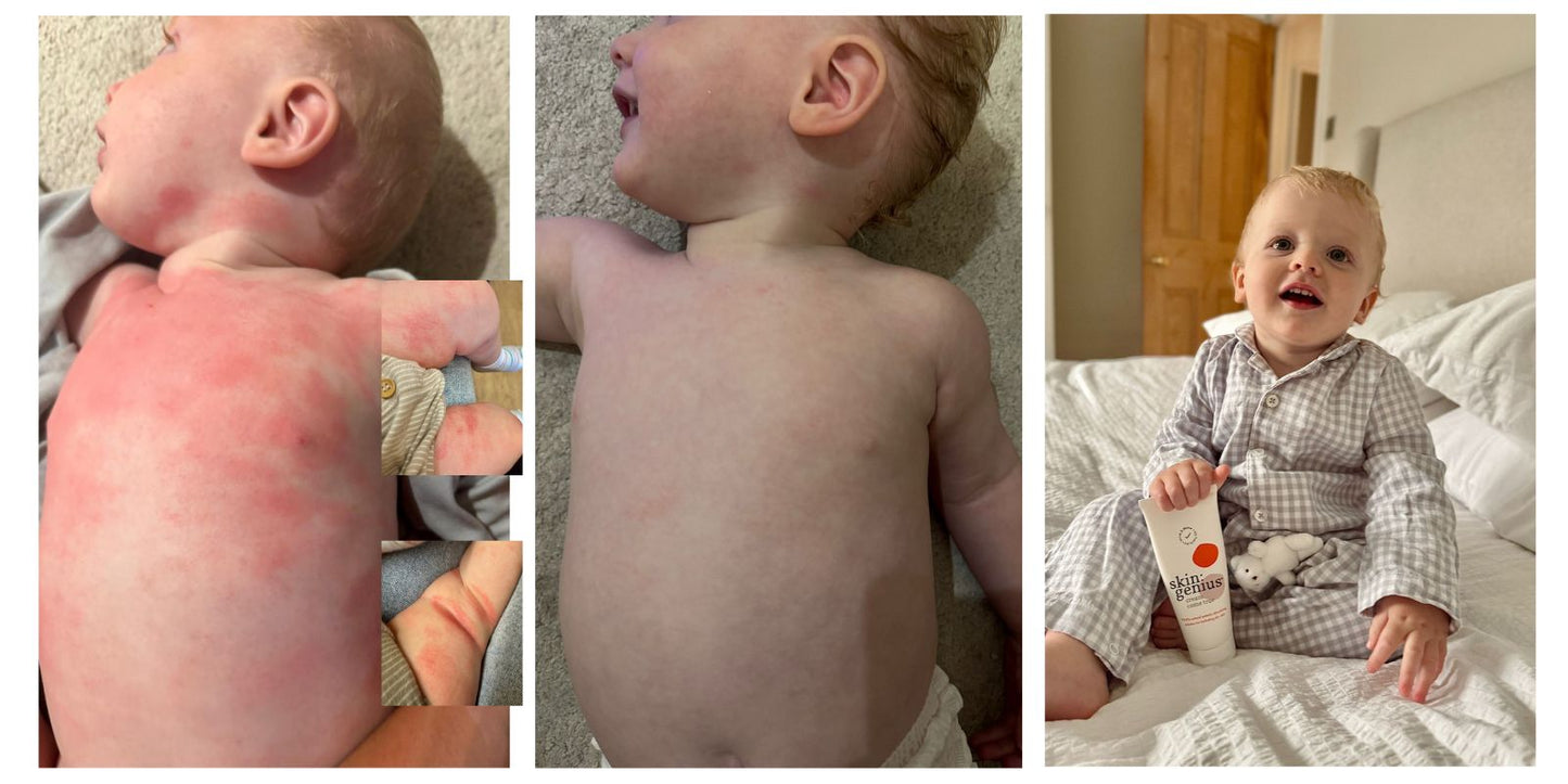 Chance meeting transformed Alfie's eczema