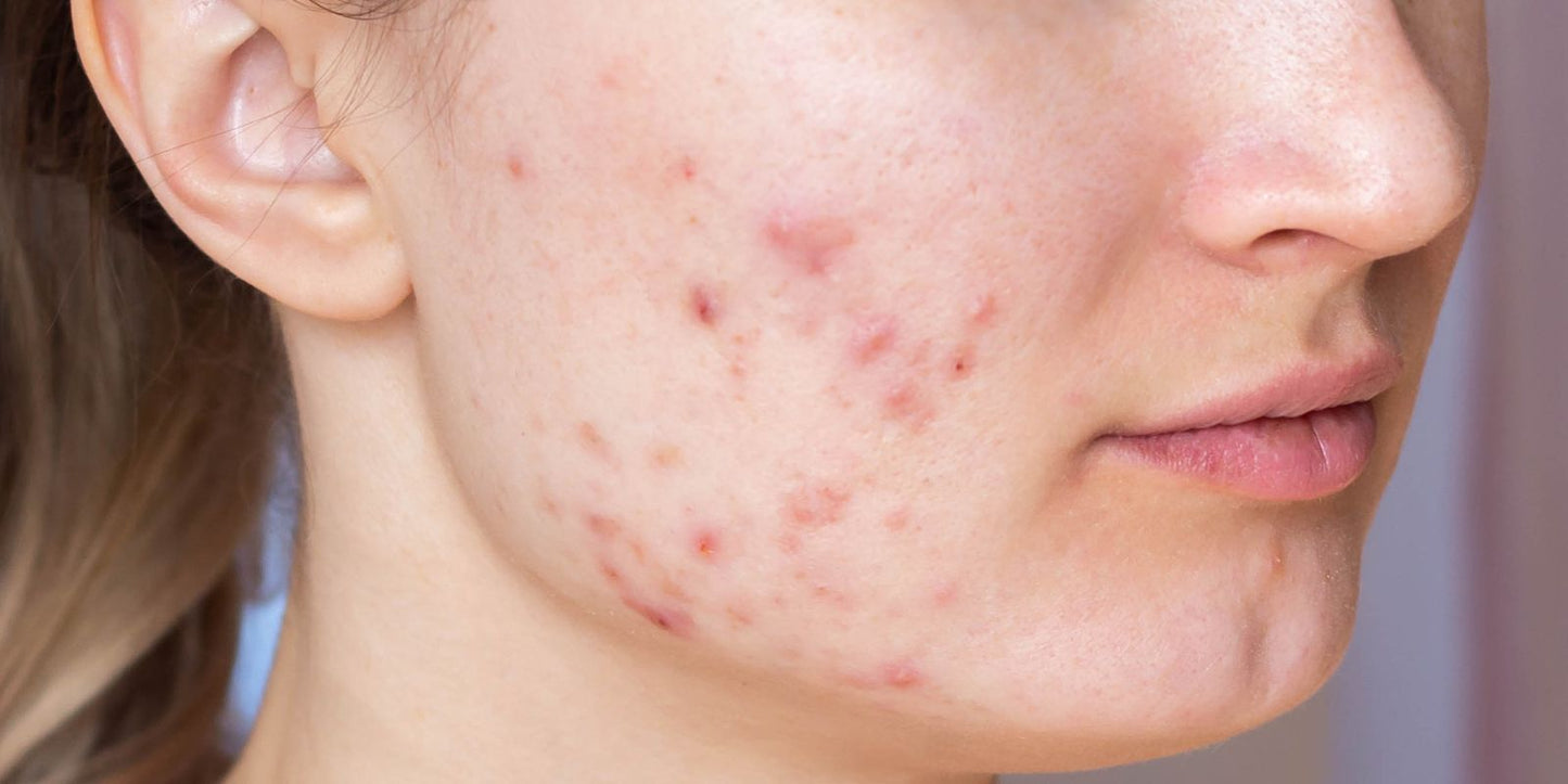 Let’s Talk About Acne with Isabelle Nunn MPHARM (Hons) Dip NT, our Resident Expert