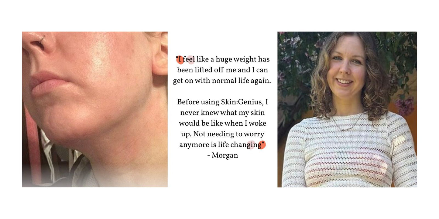 “Not needing to worry about my eczema anymore is lifechanging”