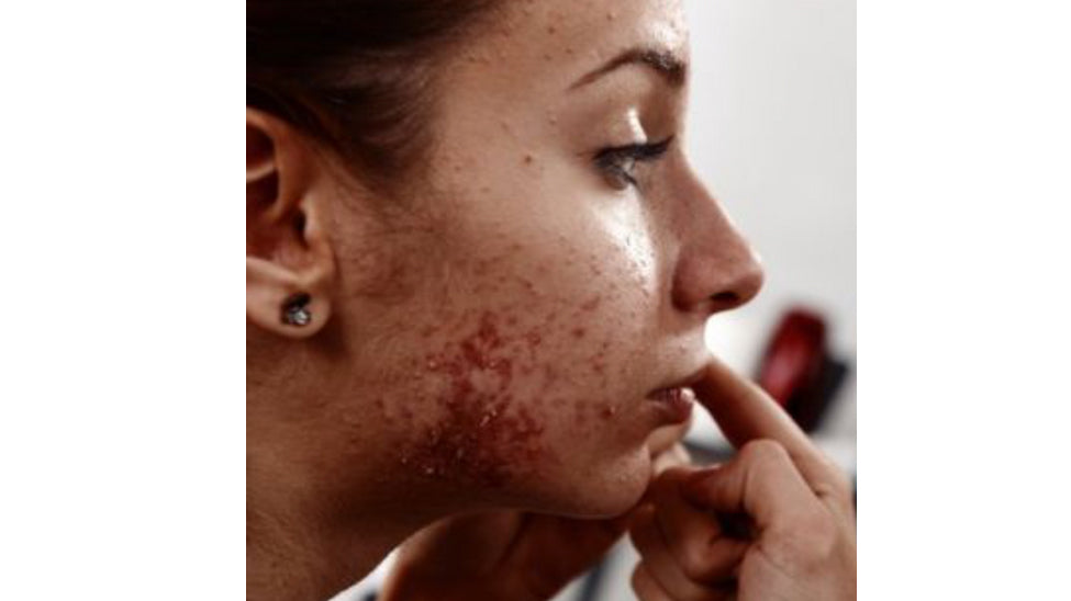 Ditch the acne medicine - tackle it naturally skin:genius