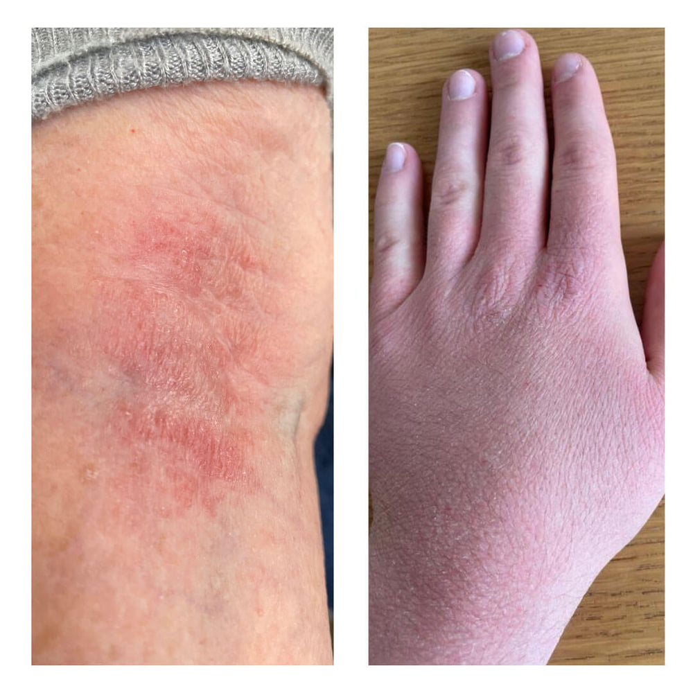 Before and after skin using Skin Genius eczema cream and oil