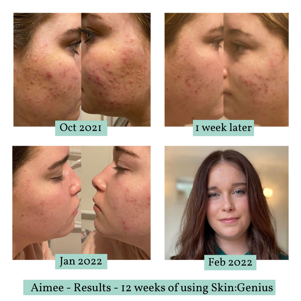 
                  
                    before and after acne treatment 
                  
                